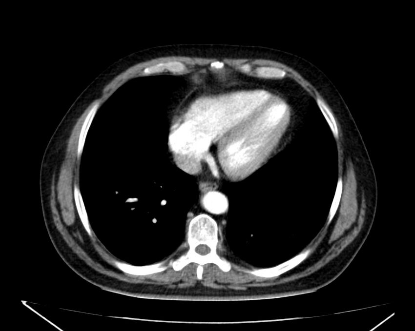 Carcinoid tumor with hepatic metastases (Radiopaedia 22651-22670 B 5).jpg