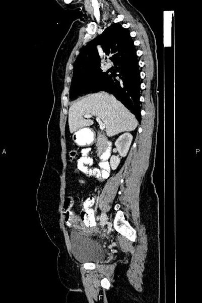 File:Carcinoma of uterine cervix (Radiopaedia 85861-101700 D 29).jpg