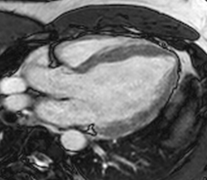 File:Cardiac sarcoidosis (Radiopaedia 39811-42243 LVOT cine images 5).jpg