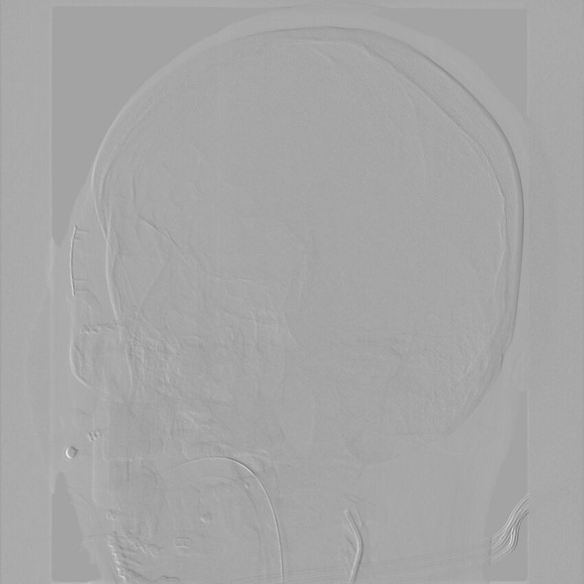 Caroticocavernous fistula - direct (Radiopaedia 61660-69666 Oblique Left ICA 7).jpg