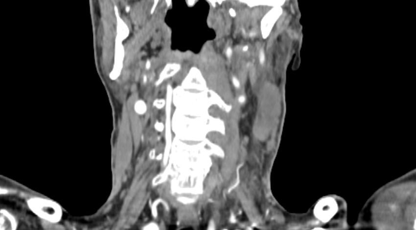 Carotid artery pseudoaneurysm (Radiopaedia 84030-99259 D 53).jpg