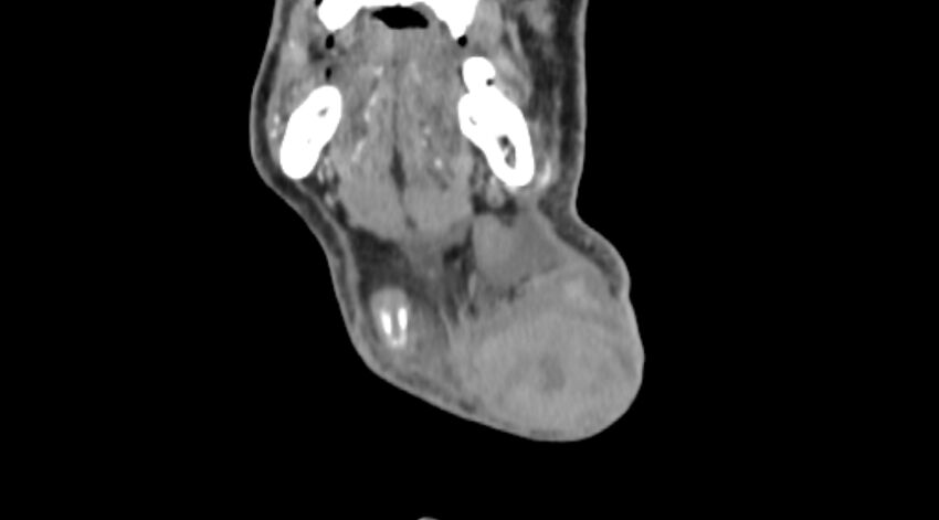 Carotid artery pseudoaneurysm (Radiopaedia 84030-99259 D 7).jpg