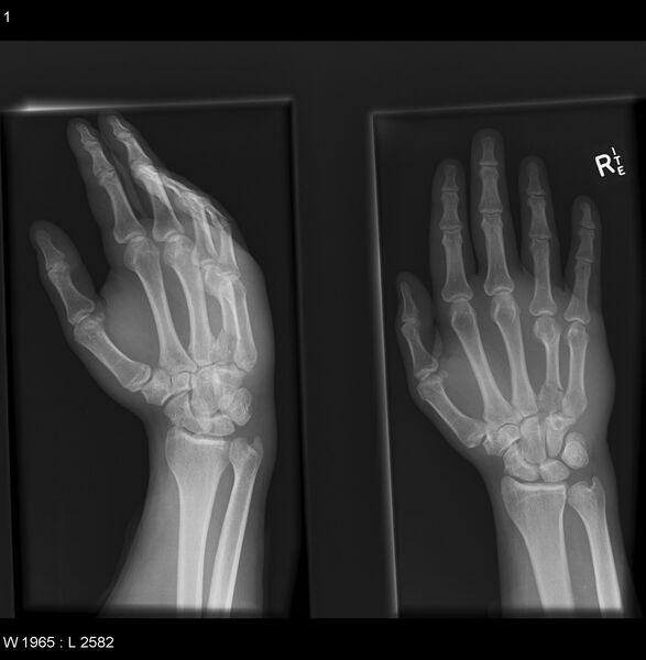 File:Carpometacarpal fracture dislocation (Radiopaedia 12281-12576 A 1).jpg