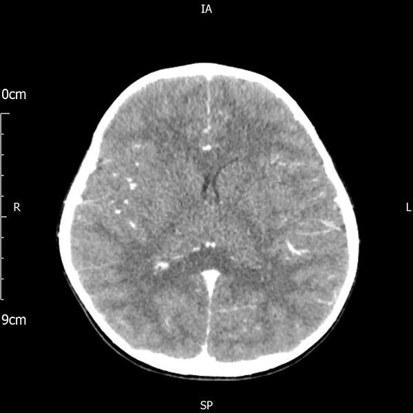 File:Cavernous sinus thrombosis (Radiopaedia 79414-92510 Axial Brain 112).jpg