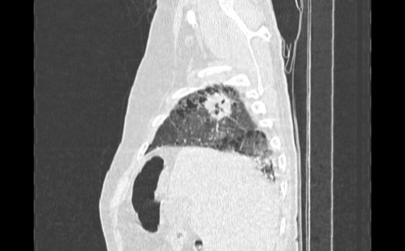 File:Cavitating bronchogenic carcinoma (Radiopaedia 44489-48162 Sagittal lung window 3).jpg