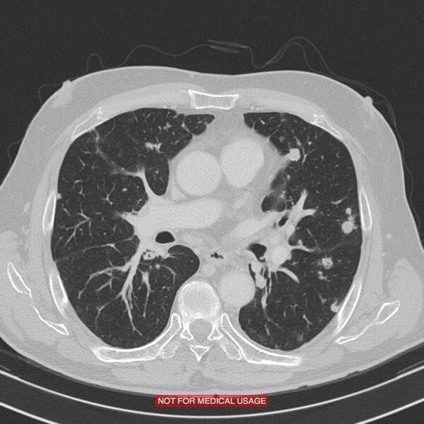 File:Cavitating pulmonary metastases (Radiopaedia 24920-25184 Axial lung window 11).jpg