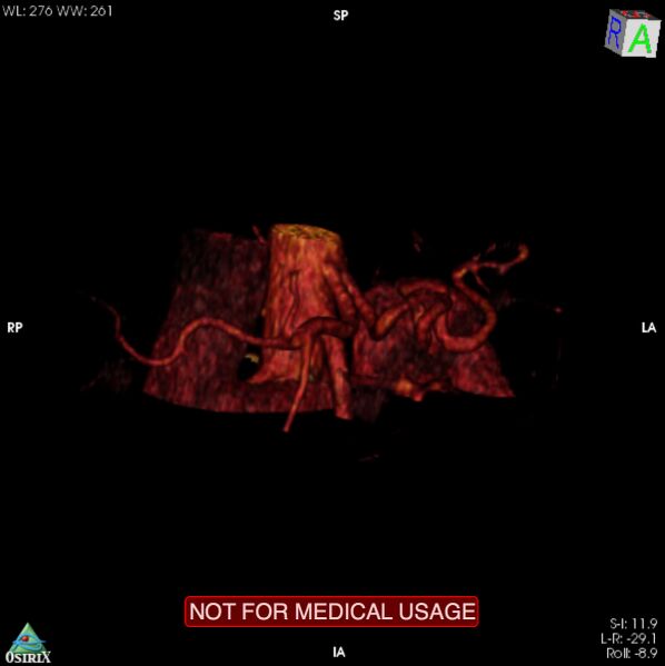 File:Celiac trunk variant anatomy - gastrohepatic trunk and splenic artery (Radiopaedia 38815-40995 B 2).jpg