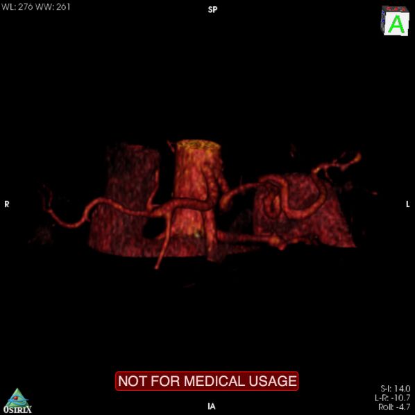 File:Celiac trunk variant anatomy - gastrohepatic trunk and splenic artery (Radiopaedia 38815-40995 B 6).jpg