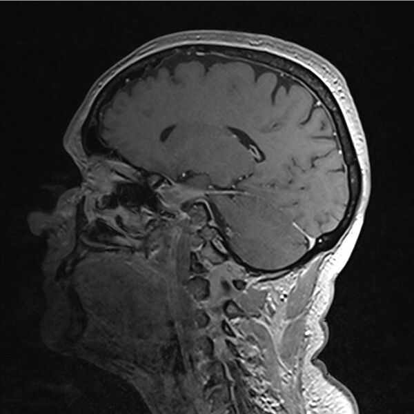 File:Central base of skull meningioma (Radiopaedia 53531-59549 Sagittal T1 C+ 8).jpg