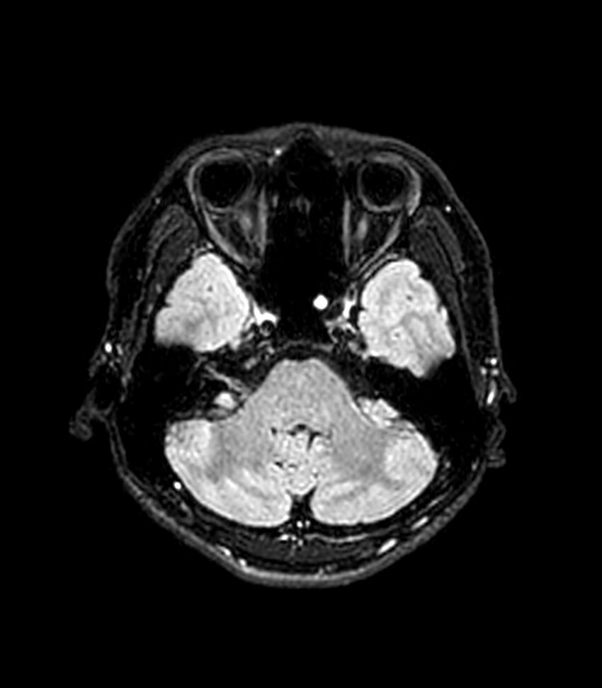 Central neurocytoma (Radiopaedia 79320-92380 Axial FLAIR 228).jpg