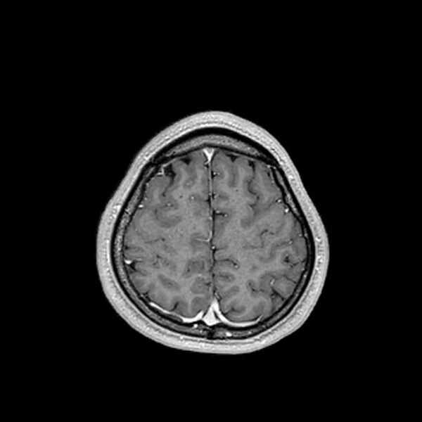 File:Central neurocytoma (Radiopaedia 79320-92380 Axial T1 C+ 195).jpg