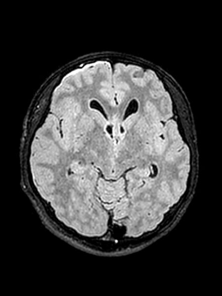 File:Central neurocytoma (Radiopaedia 79320-92381 Axial FLAIR 98).jpg