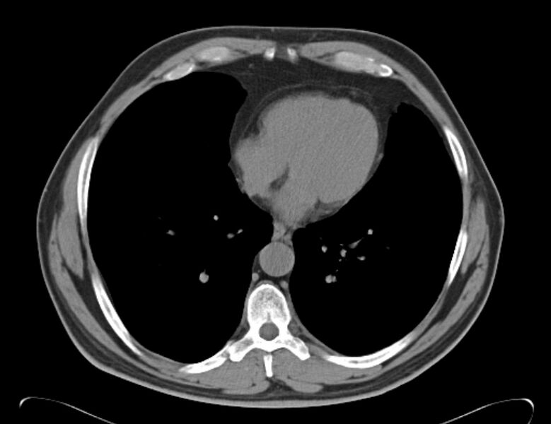 File:Centrilobular pulmonary emphysema (Radiopaedia 26808-26971 Axial non-contrast 30).jpg