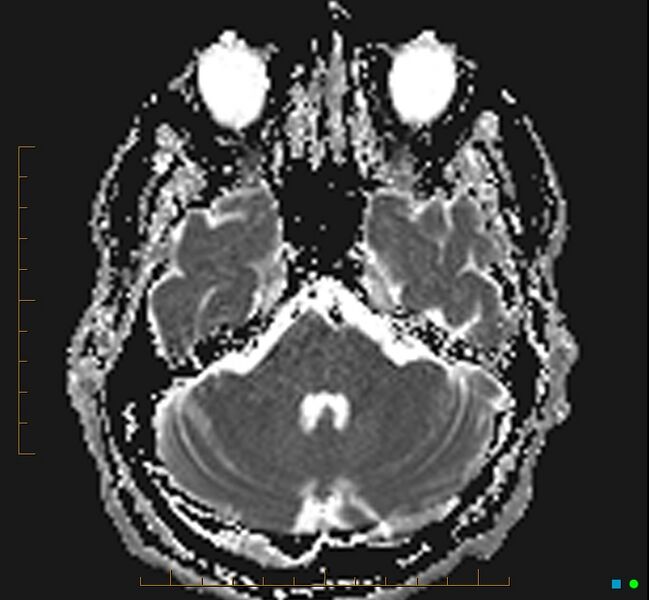 File:Cerebellar gangliocytoma (Radiopaedia 65377-74422 Axial ADC 10).jpg