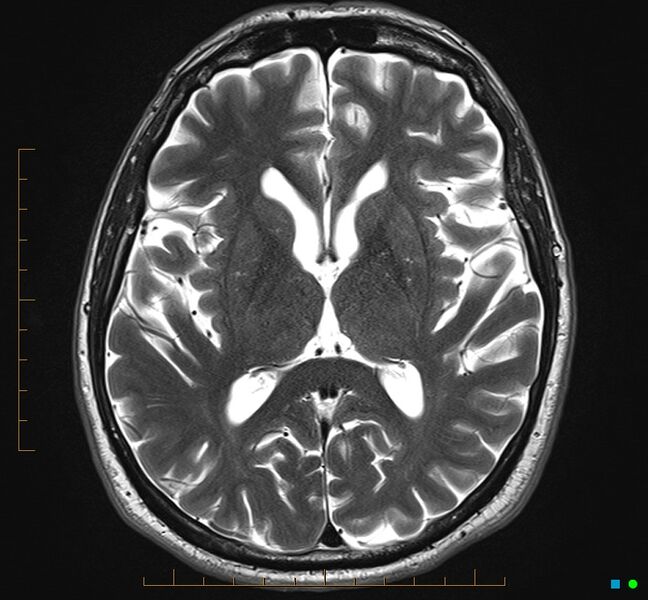 File:Cerebellar gangliocytoma (Radiopaedia 65377-74422 Axial T2 20).jpg