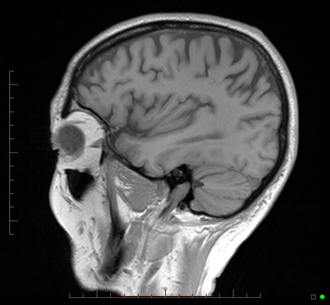 File:Cerebellar gangliocytoma (Radiopaedia 65377-74422 Sagittal T1 10).jpg