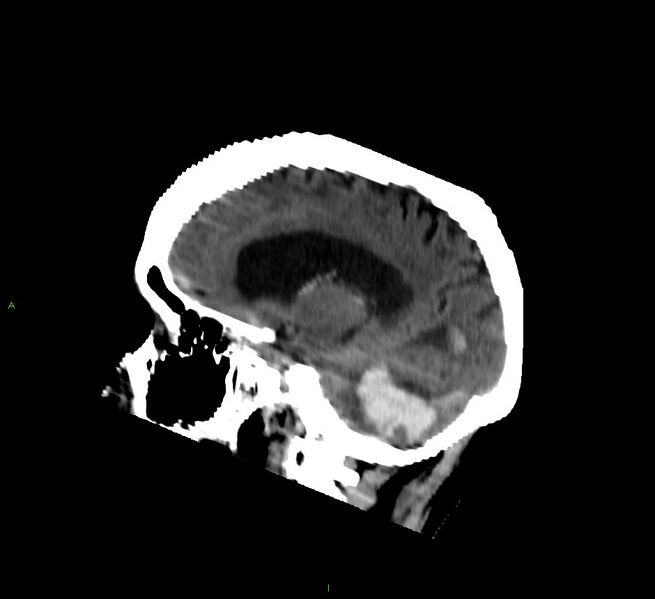 File:Cerebellar hemorrhage (Radiopaedia 58792-66026 C 20).jpg