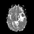 Cerebral abscess post cardiac surgery (Radiopaedia 27244-27420 Axial ADC 11).jpg