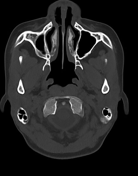 File:Cerebral abscesses (Radiopaedia 70458-80568 Axial bone window 10).jpg