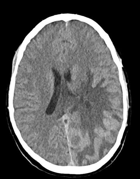 File:Cerebral abscesses (Radiopaedia 70458-80568 Axial non-contrast 37).jpg