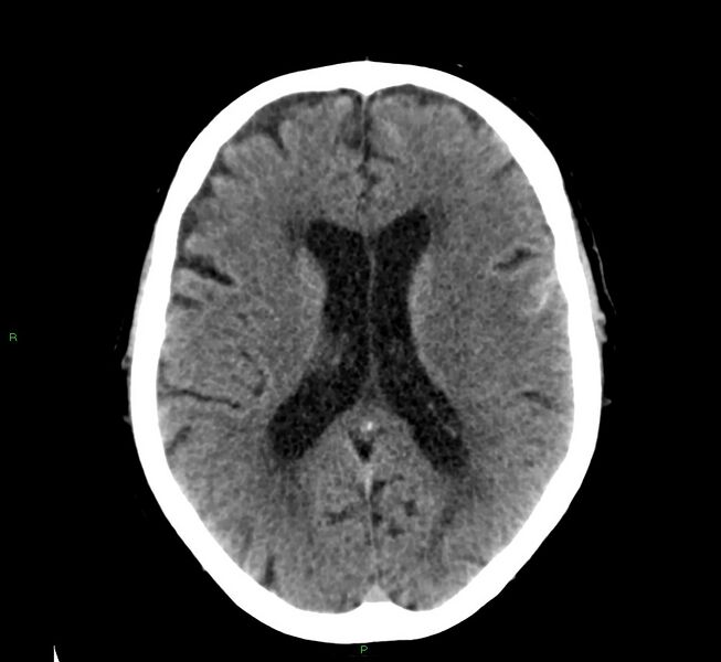 File:Cerebral amyloid angiopathy-associated lobar intracerebral hemorrhage (Radiopaedia 58376-65511 Axial non-contrast 27).jpg