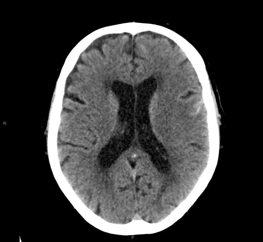 Cerebral amyloid angiopathy-associated lobar intracerebral hemorrhage (Radiopaedia 58376-65511 Axial non-contrast 27).jpg