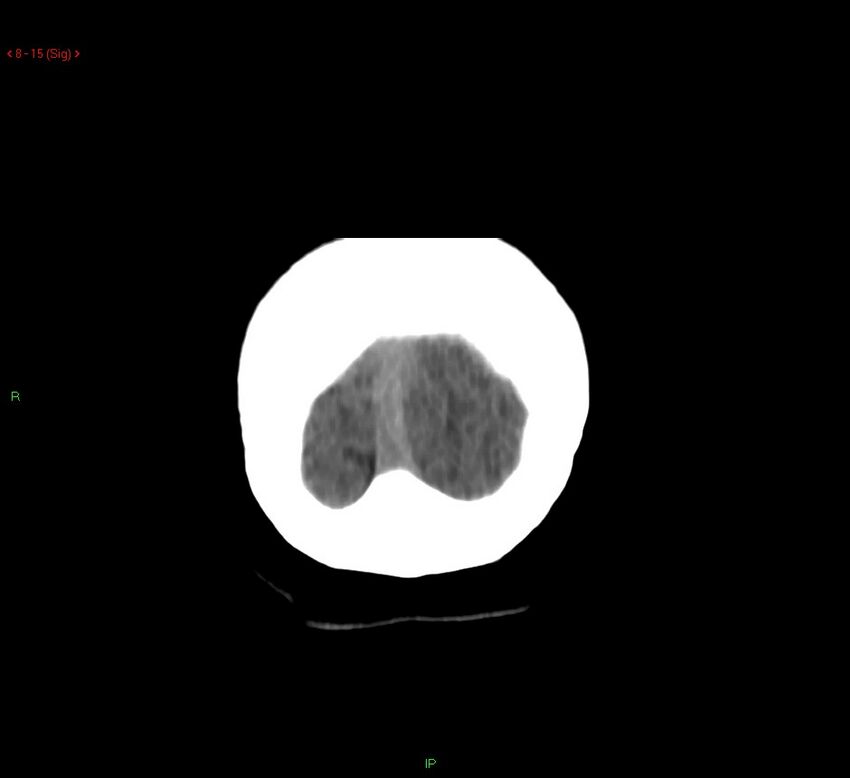 Cerebral amyloid angiopathy-associated lobar intracerebral hemorrhage (Radiopaedia 58378-65518 Coronal non-contrast 15).jpg