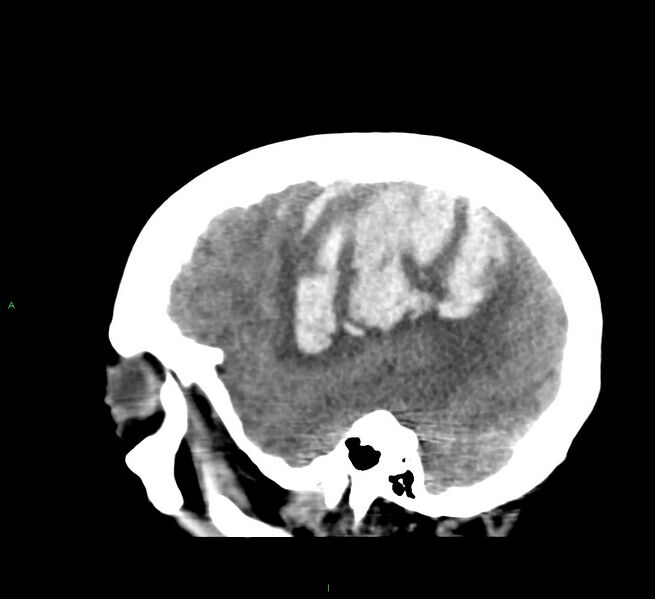 File:Cerebral amyloid angiopathy-associated lobar intracerebral hemorrhage (Radiopaedia 58379-65519 C 13).jpg