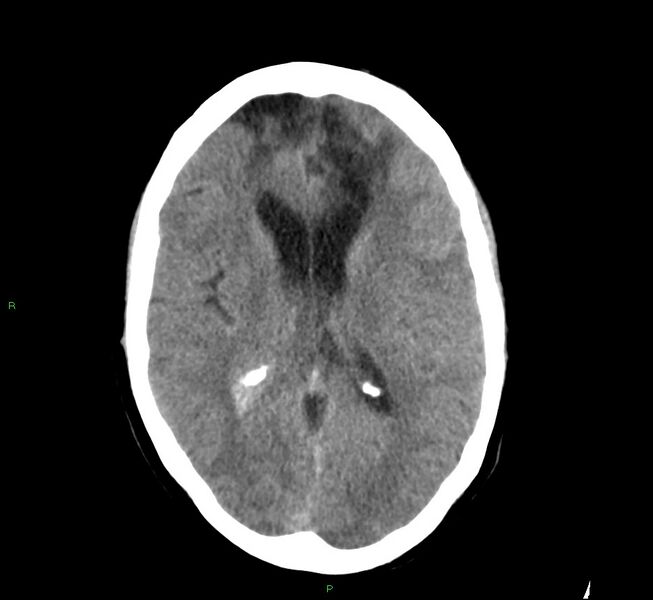 File:Cerebral amyloid angiopathy-associated lobar intracerebral hemorrhage (Radiopaedia 58529-65686 Axial non-contrast 14).jpg