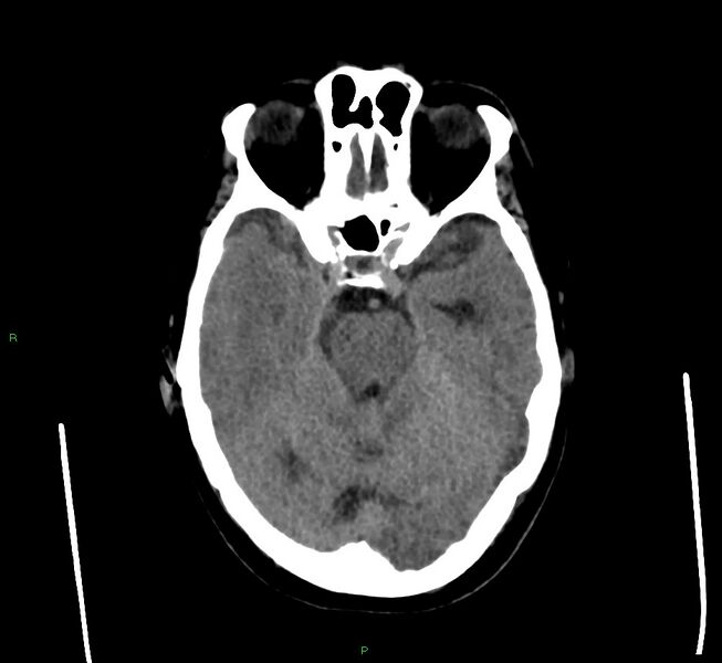 File:Cerebral amyloid angiopathy-associated lobar intracerebral hemorrhage (Radiopaedia 58560-65723 Axial non-contrast 36).jpg