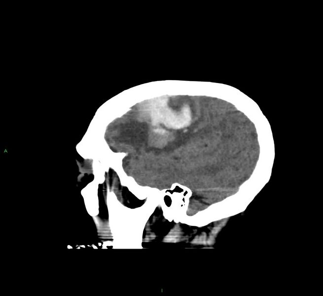 File:Cerebral amyloid angiopathy-associated lobar intracerebral hemorrhage (Radiopaedia 58560-65723 C 11).jpg