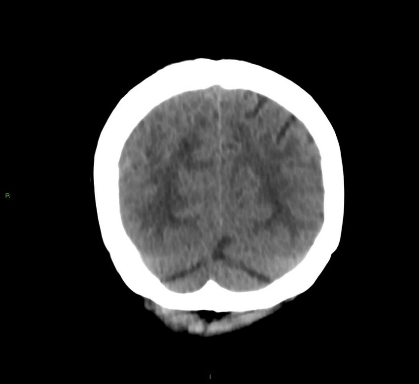 Cerebral amyloid angiopathy-associated lobar intracerebral hemorrhage (Radiopaedia 58566-65730 Coronal non-contrast 17).jpg