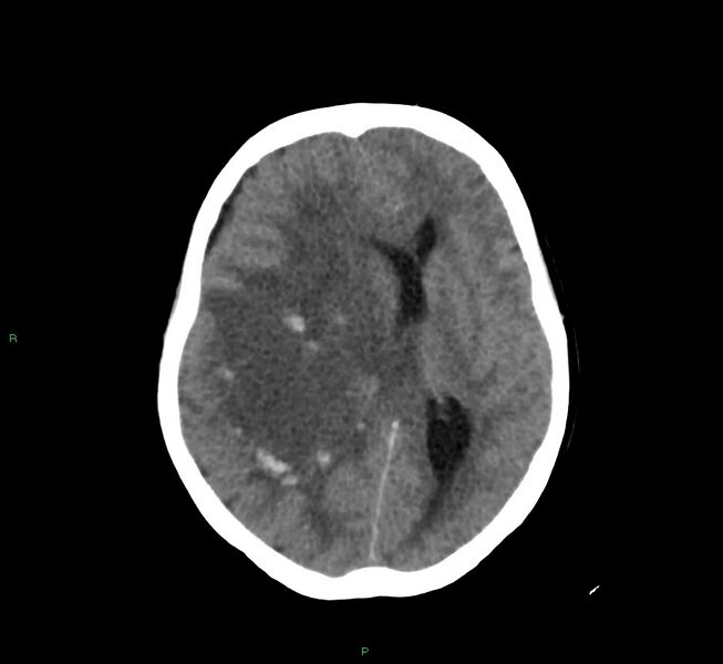 File:Cerebral amyloid angiopathy-associated lobar intracerebral hemorrhage (Radiopaedia 58751-65972 Axial non-contrast 24).jpg
