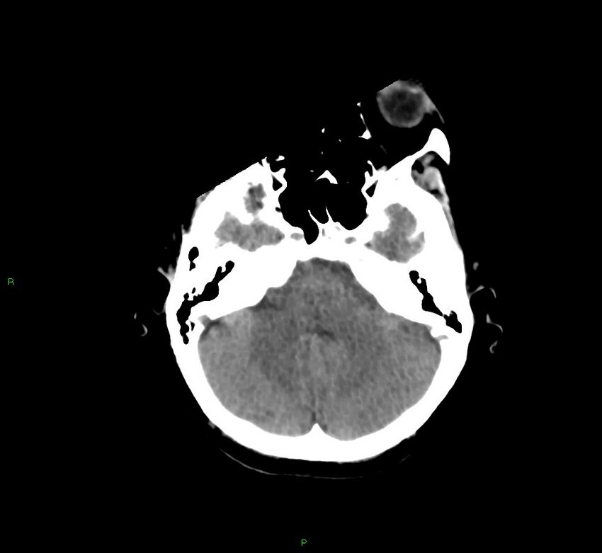 Cerebral amyloid angiopathy-associated lobar intracerebral hemorrhage (Radiopaedia 58754-65975 Axial non-contrast 46).jpg