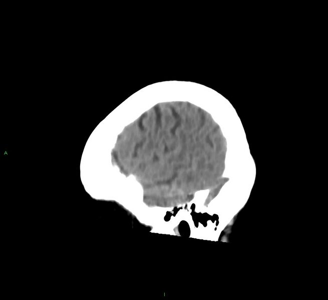 File:Cerebral amyloid angiopathy-associated lobar intracerebral hemorrhage (Radiopaedia 58754-65975 C 7).jpg