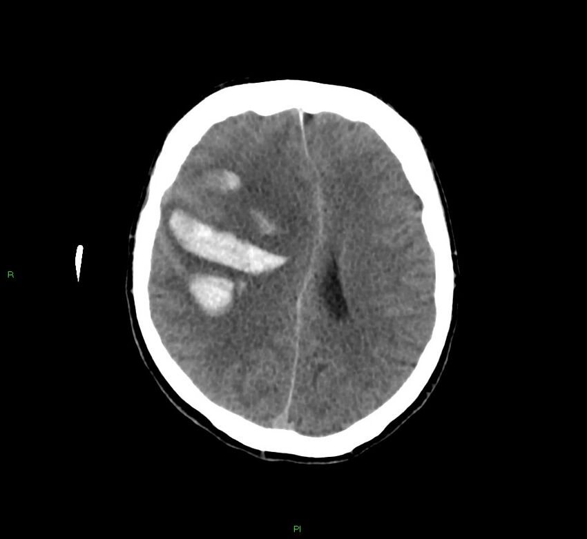 Cerebral amyloid angiopathy-associated lobar intracerebral hemorrhage (Radiopaedia 58756-65977 Axial non-contrast 22).jpg