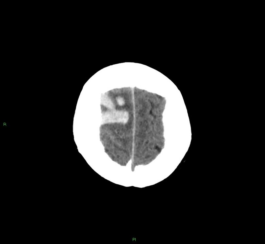 Cerebral amyloid angiopathy-associated lobar intracerebral hemorrhage (Radiopaedia 58756-65977 Axial non-contrast 9).jpg