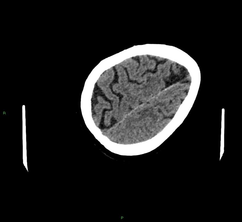 Cerebral amyloid angiopathy-associated lobar intracerebral hemorrhage (Radiopaedia 58757-65979 Axial non-contrast 119).jpg
