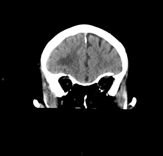 File:Cerebral amyloid angiopathy-associated lobar intracerebral hemorrhage (Radiopaedia 59356-66716 Coronal non-contrast 50).jpg