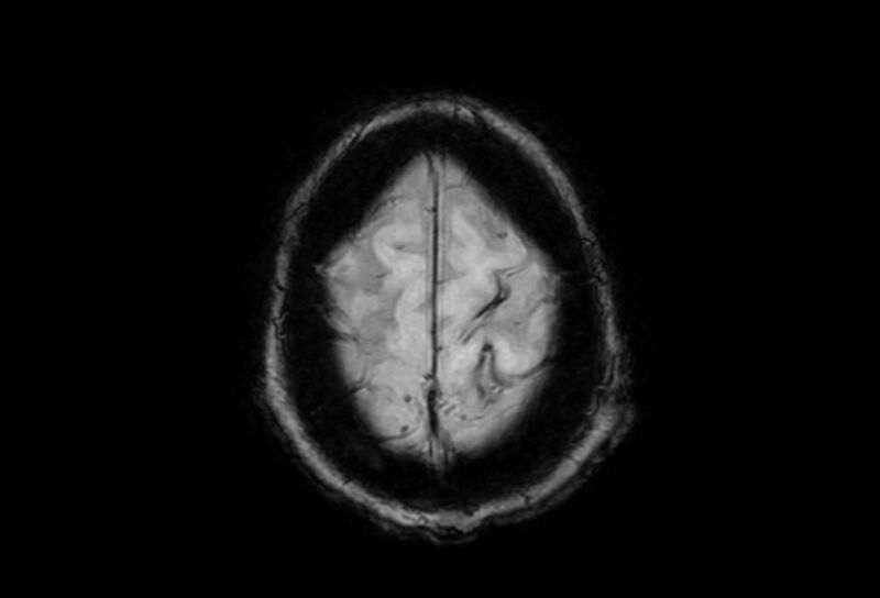 File:Cerebral amyloid angiopathy (Radiopaedia 86671-102792 Axial Gradient Echo 5).jpg