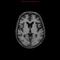 Cerebral and orbital tuberculomas (Radiopaedia 13308-13311 Axial T1 11).jpg