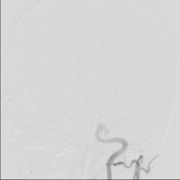 File:Cerebral aneurysm with rupture (Radiopaedia 29933-30458 LT ICA IC 12).jpg