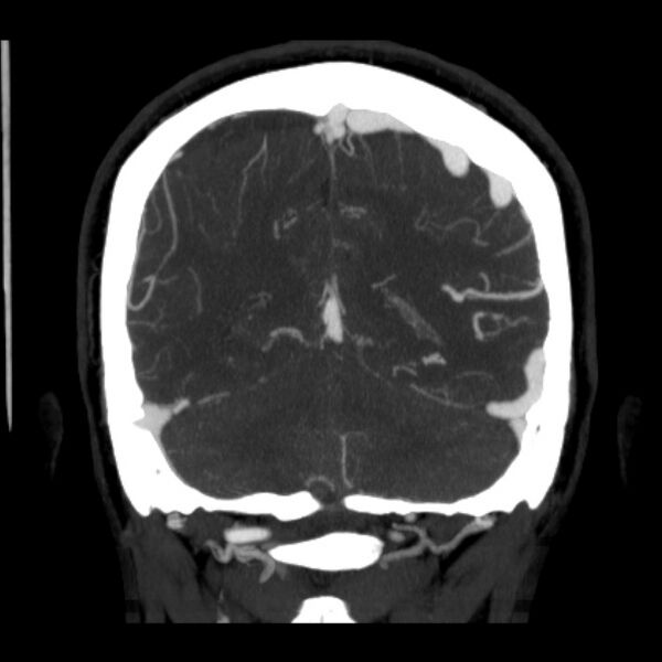 File:Cerebral arteriovenous malformation (Radiopaedia 43729-47189 C 35).jpg