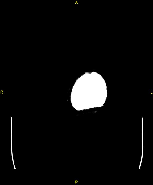 File:Cerebral autosomal dominant arteriopathy with subcortical infarcts and leukoencephalopathy (CADASIL) (Radiopaedia 86108-102051 Axial non-contrast 118).jpg