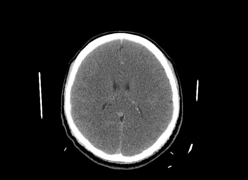 File:Cerebral edema (Radiopaedia 82519-96661 Axial non-contrast 23).jpg