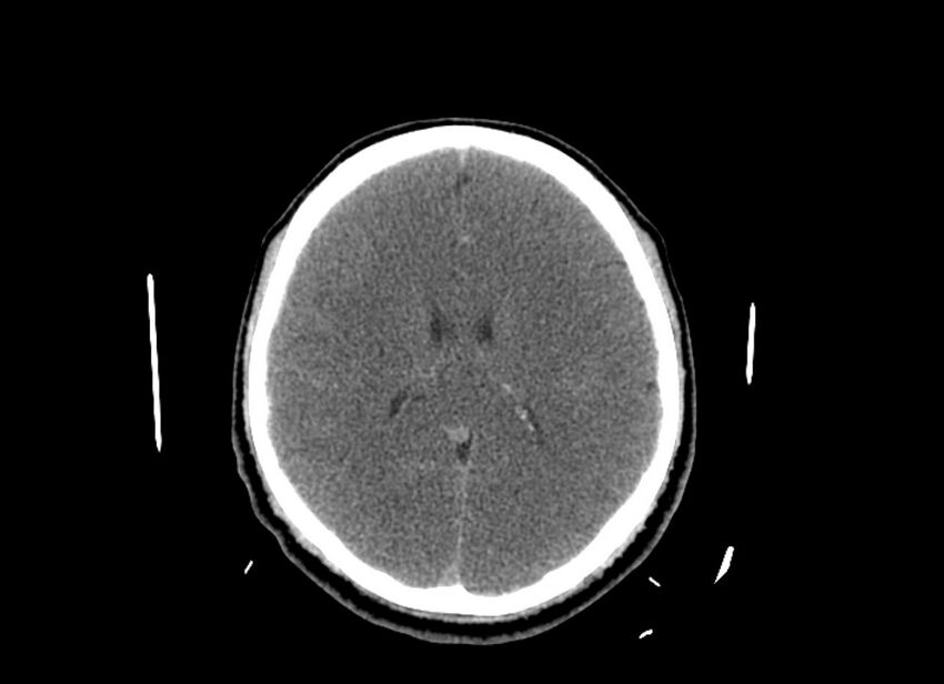Cerebral edema (Radiopaedia 82519-96661 Axial non-contrast 23).jpg