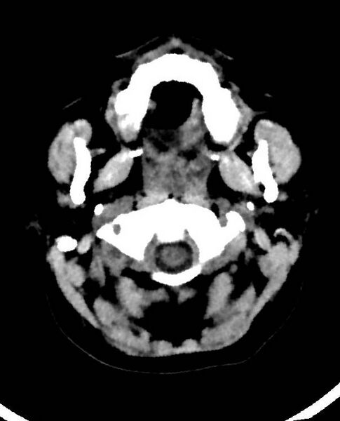 File:Cerebral edema due to severe hyponatremia (Radiopaedia 89826-106938 Axial non-contrast 6).jpg