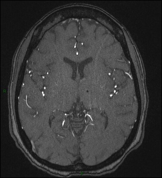 File:Cerebral fat embolism (Radiopaedia 35022-36525 Axial TOF 107).jpg
