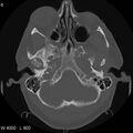 Cerebral hemorrhagic contusion with subdural and subarachnoid hemorrhage (Radiopaedia 10680-11146 Axial bone window 6).jpg