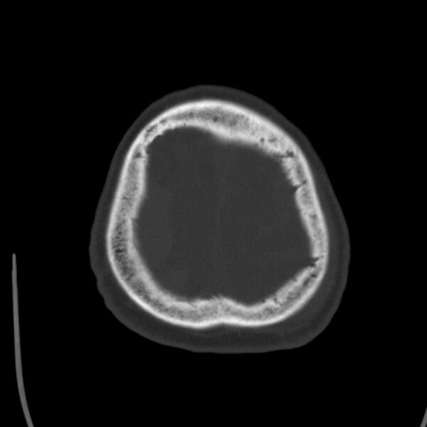 File:Cerebral hemorrhagic contusions (Radiopaedia 23145-23188 Axial bone window 51).jpg